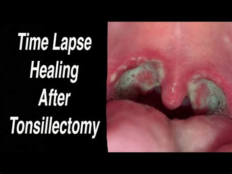 <b>Tonsillectomy</b>, removal of the tonsils <b>and</b>/or adenoids (<b>adenoidectomy</b>), can be an option when infections return frequently even after antibiotic therapy or there is difficulty breathing with the enlarged tonsils <b>and</b>/or adenoids. . Tonsillectomy and adenoidectomy recovery day by day